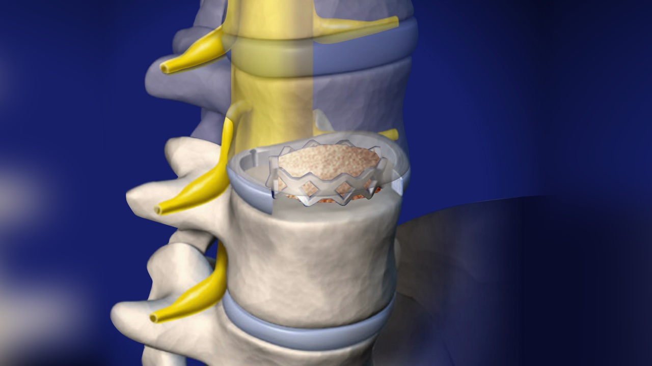 Spine Surgery | Summit Orthopedics Treatment Guide