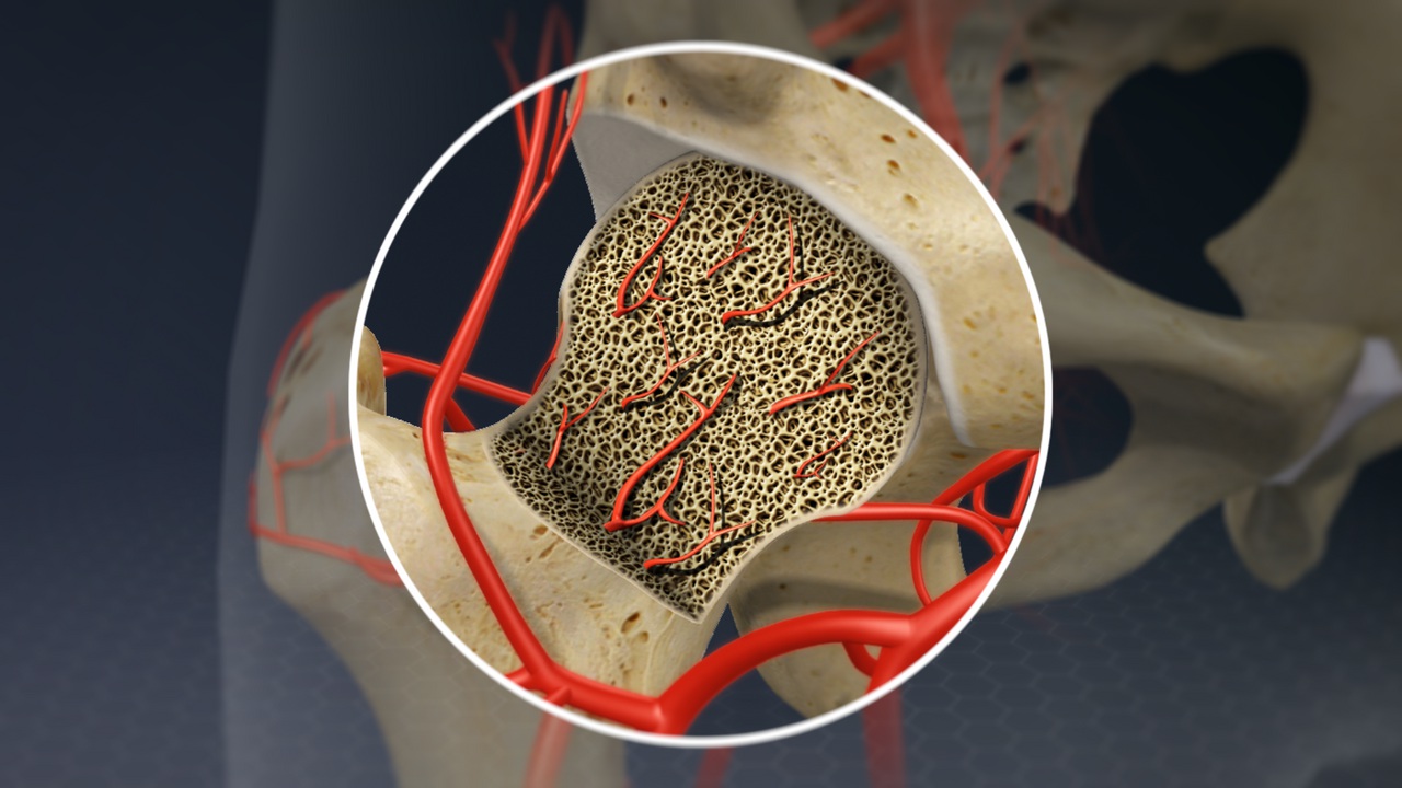 Avascular Necrosis | Hip & Knee Replacement | Uci Health | Orange County, Ca