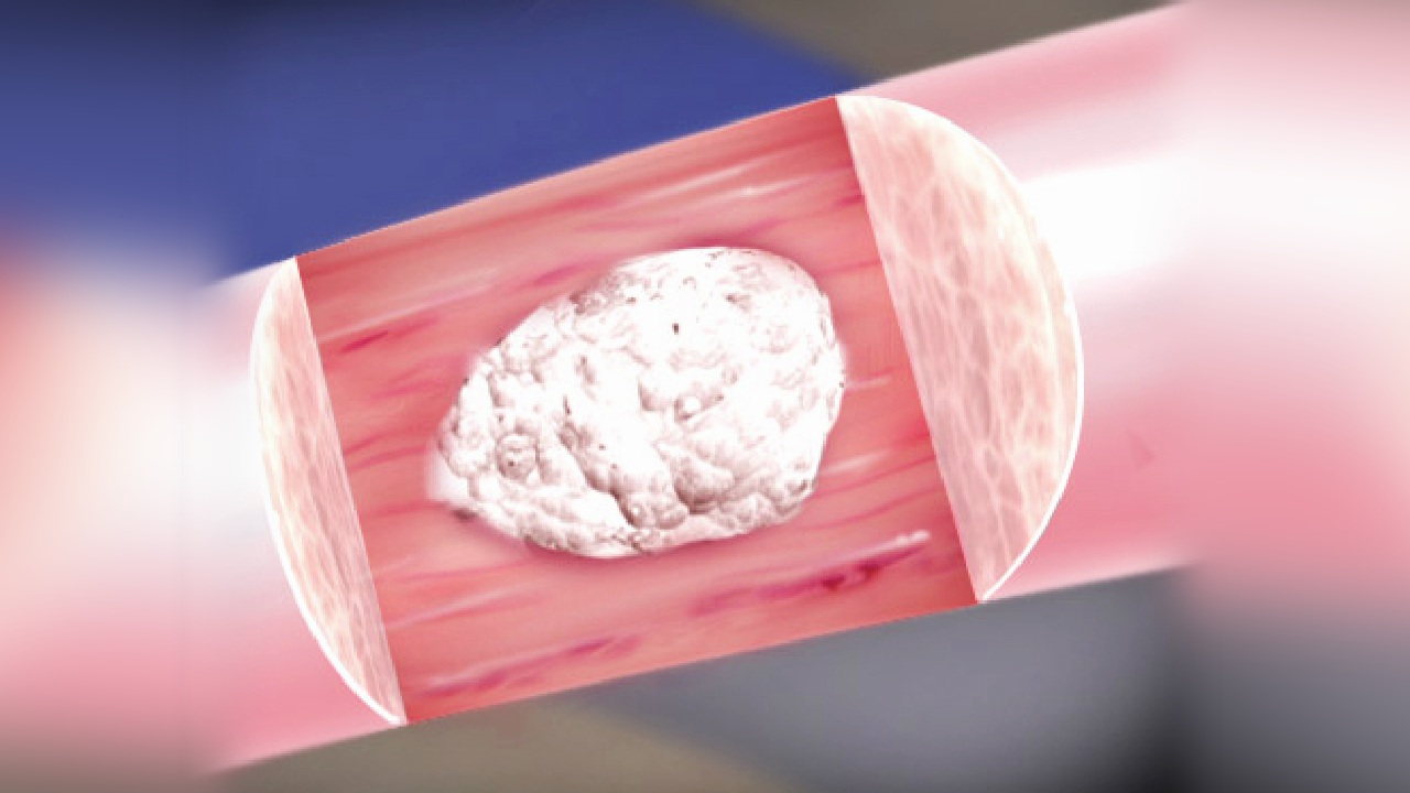 Calcium Deposits In The Shoulder | Southern California Orthopedic Institute