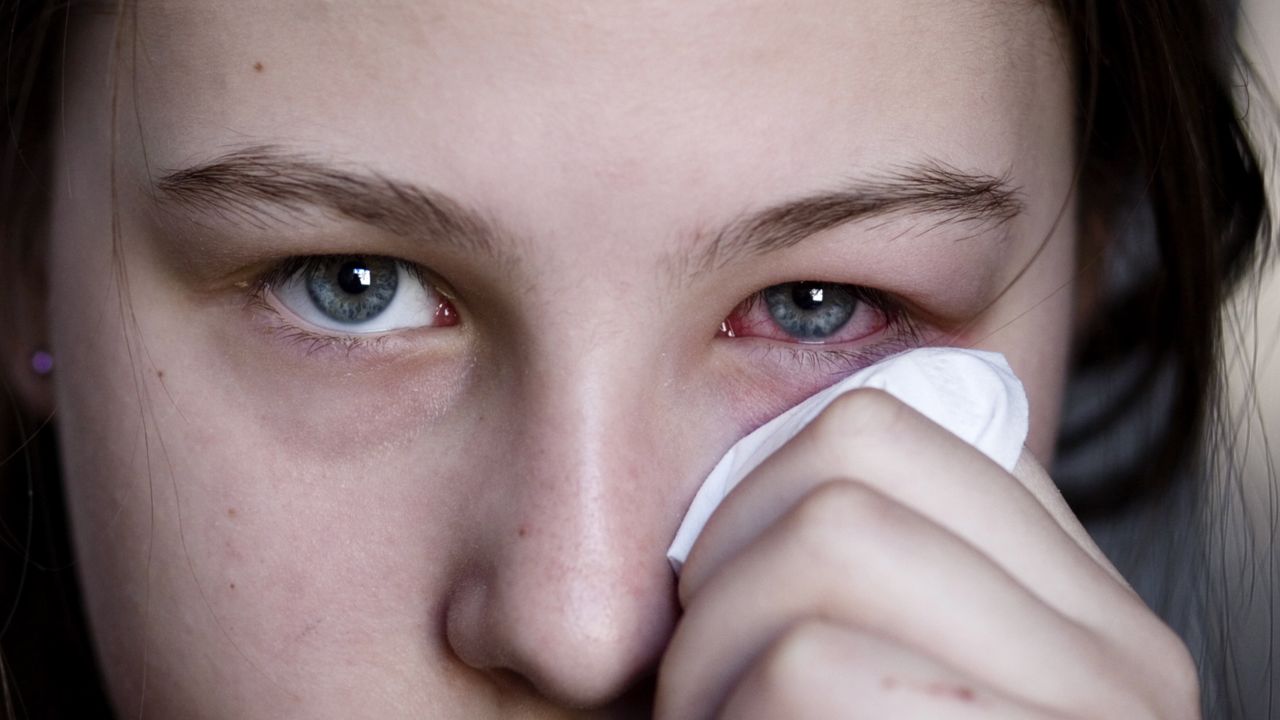 Conjunctivitis (Pink Eye) in Children