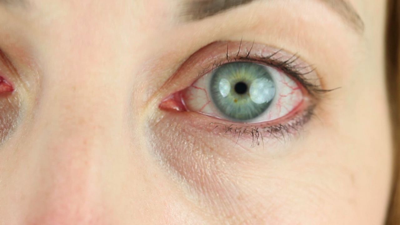 Conjunctivitis (Pink Eye)