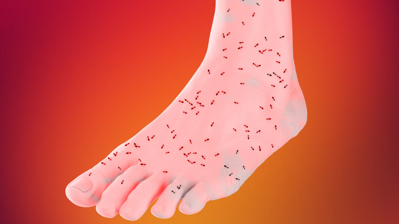 Fire Ant Bites and Stings