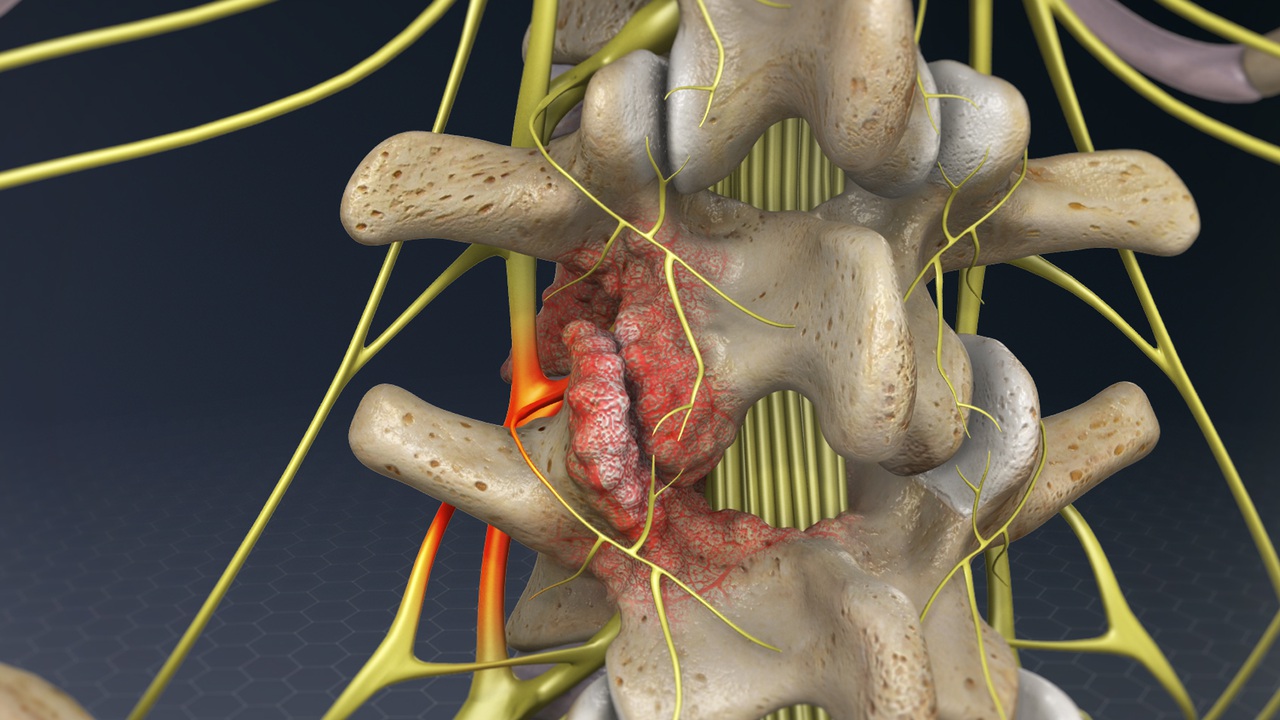 Lumbar Foraminotomy