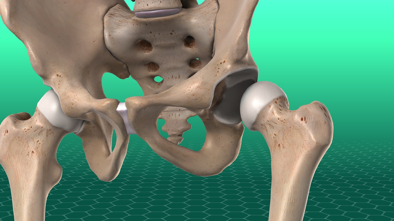 Dislocacion De Cadera Grupo Medico Ortopedico De La Costa Central Dislocacion De Cadera Grupo Medico Ortopedico De La Costa Central