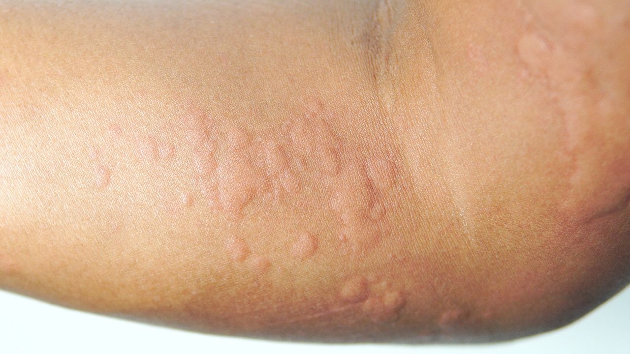Hives