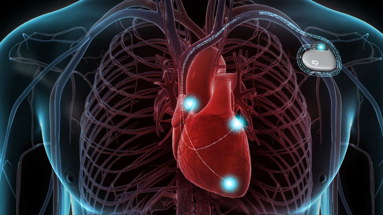 Implantable cardioverter-defibrillator