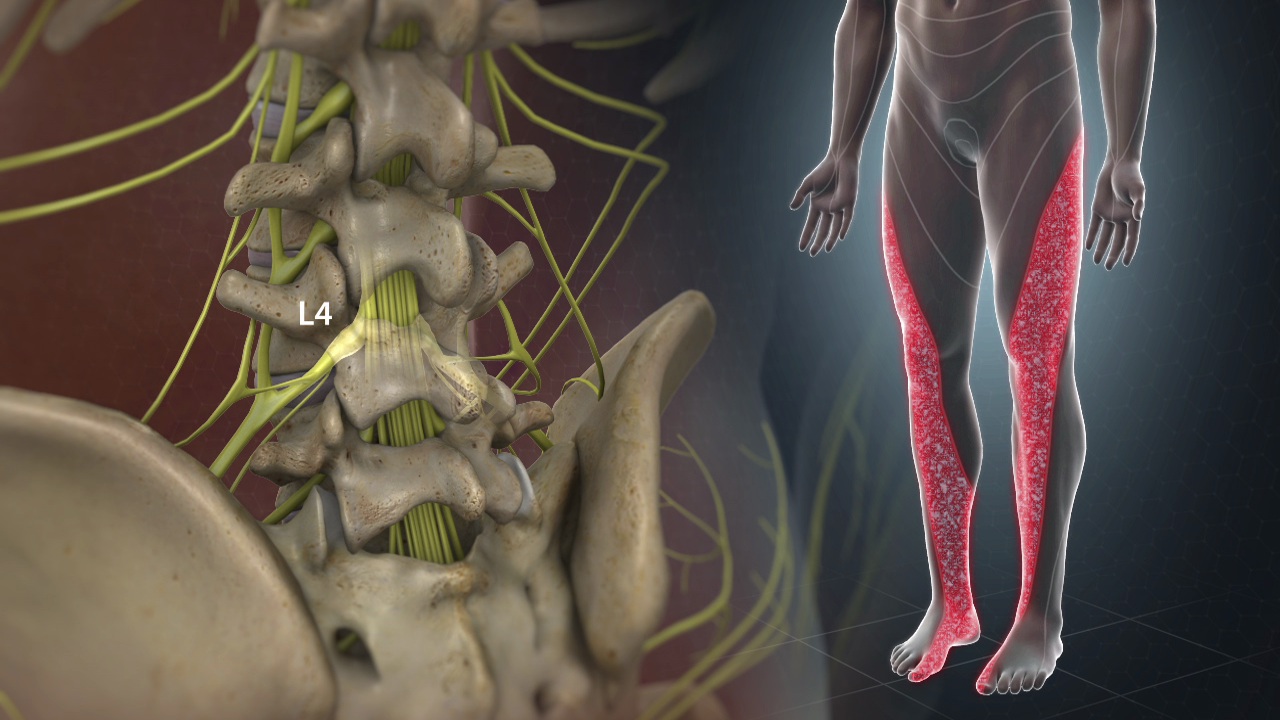 Sciatica Or Radicular Leg Pain Welcome Back Clinic Mri And Pain Management Centre
