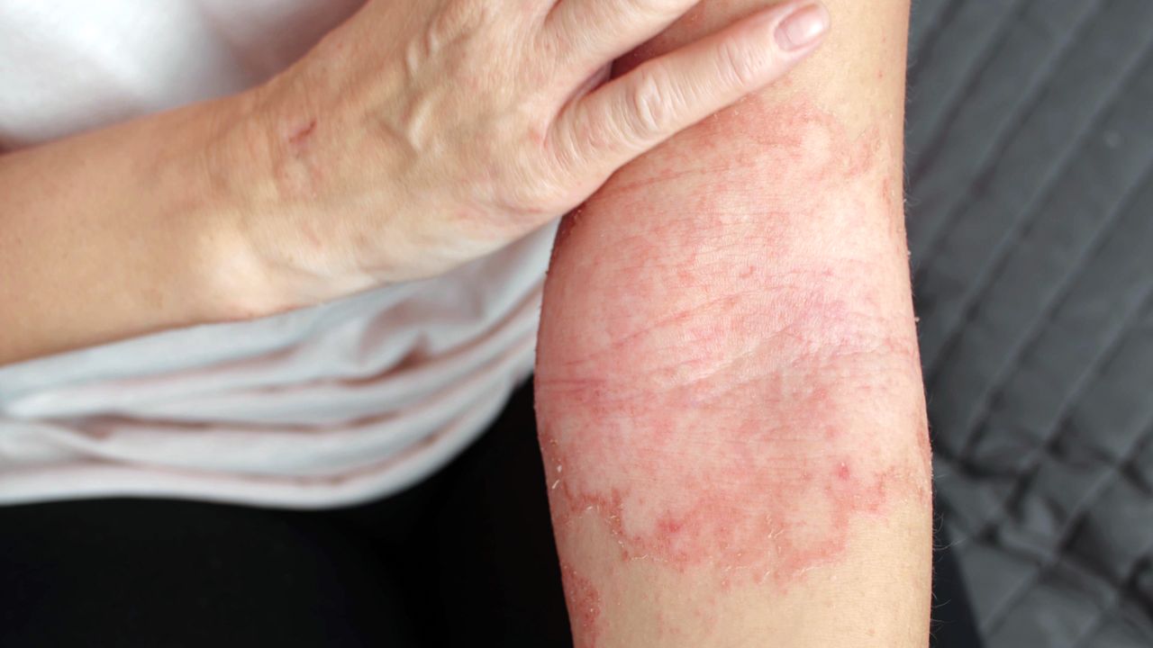 Living With Eczema