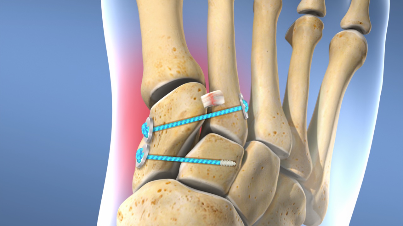 Lisfranc Ligament Repair (Suture Button Technique) | Resurgens Orthopaedics