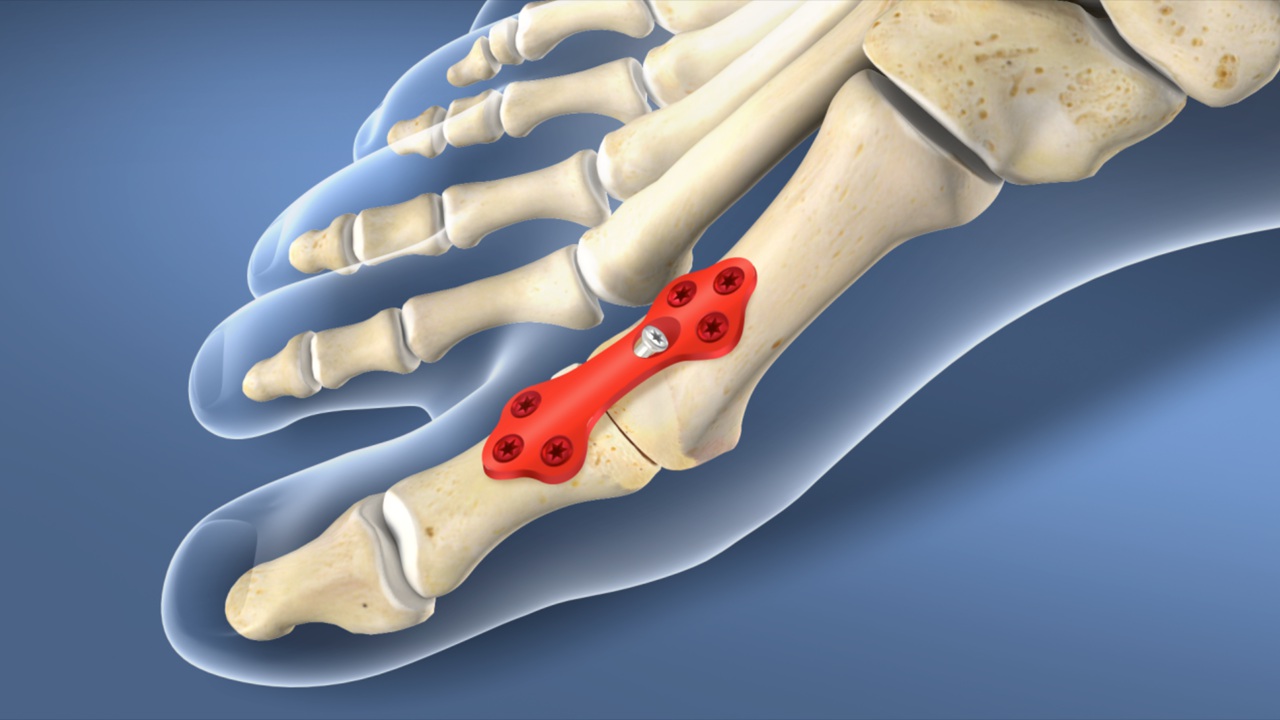 metatarsal osteoarthritis