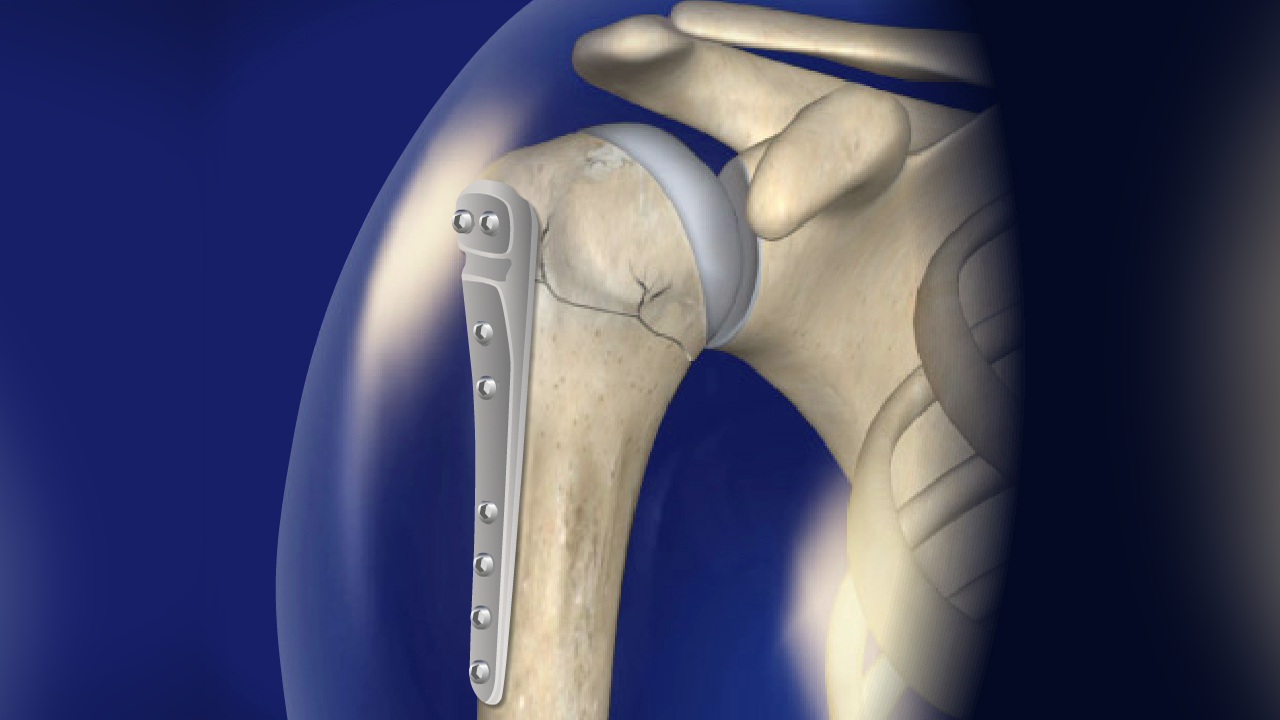 Open reduction internal fixation surgery | doctorvisit