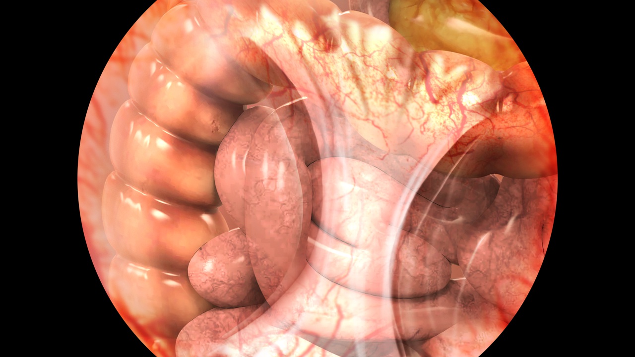 Adhesions - Willis-Knighton Health System - Shreveport - Bossier City -  Louisiana