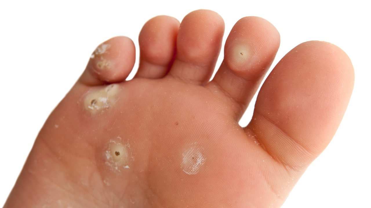 Warts Johns Hopkins Medicine Warts Johns Hopkins Medicine