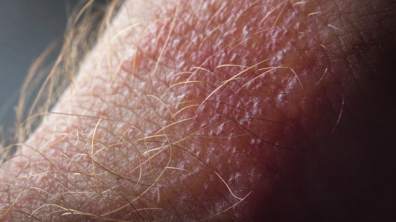 Poison Ivy, Poison Oak and Poison Sumac Reaction (Urushiol-Induced Contact Dermatitis)