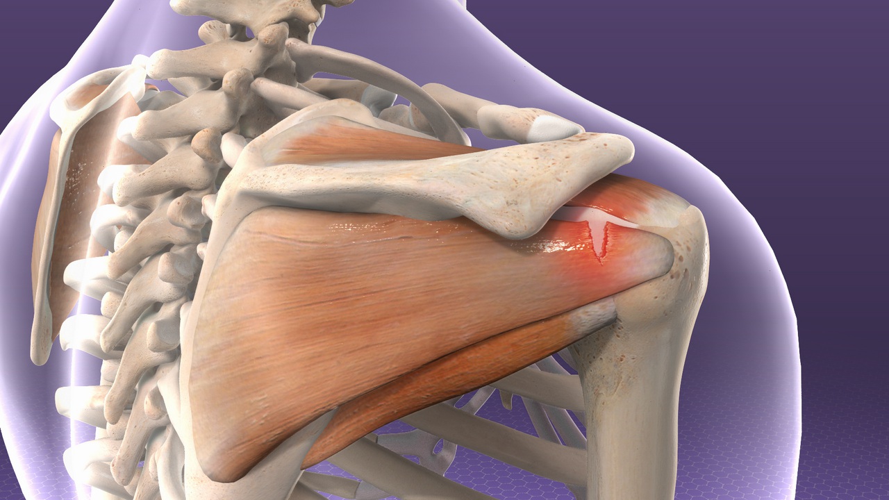 Вывих сустава закрытый перелом разрыв сухожилия. Ротаторная манжета плечевого сустава анатомия. Травматический плексит. Мышцы ротаторной манжеты плечевого сустава.