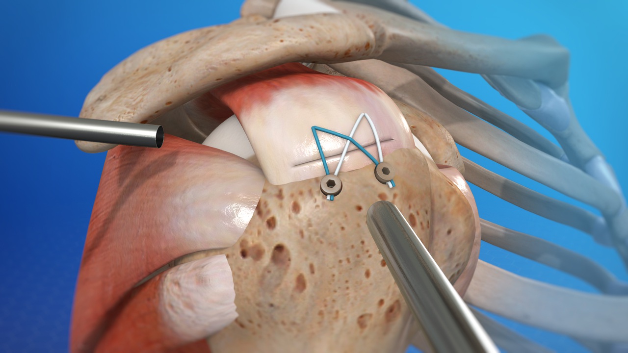 Arthroscopic Rotator Cuff Repair, Orthosports Orthopaedic Surgeons