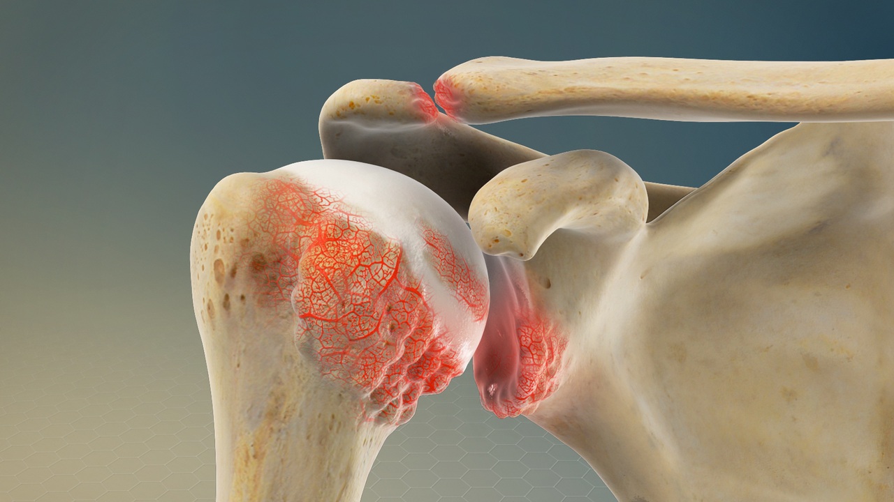 váll osteoarthritis nyaki osteoarthritis kezelése