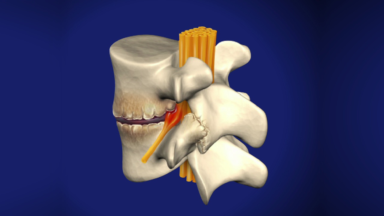 Spondylosis Center - Spinal Osteoarthritis - Symptoms Exercises Treatments