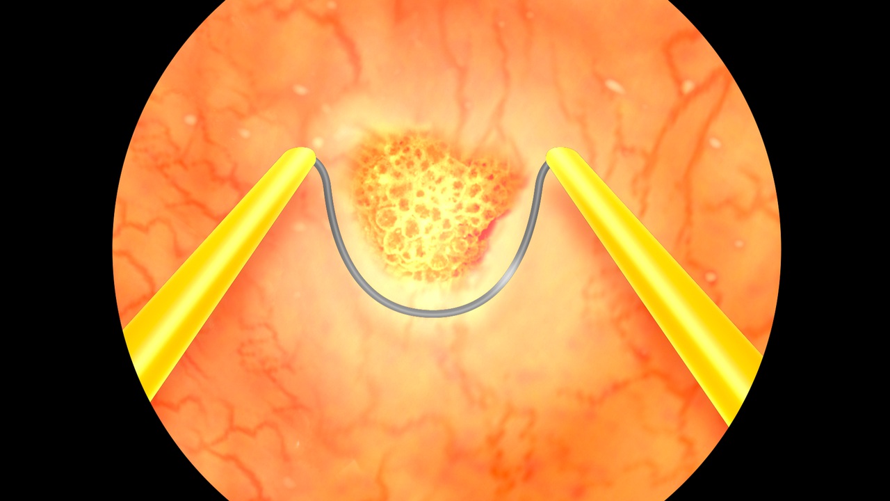 transurethral resection of the bladder