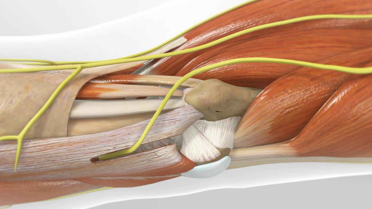 Watch Ulnar Nerve Transposition