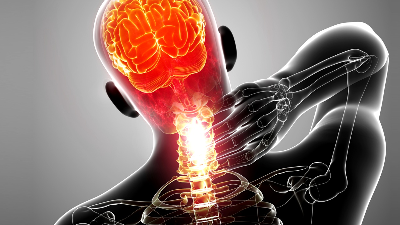Whiplash Headache Other Migraine Related Injuries Los Angeles Minimally Invasive Spine Institute